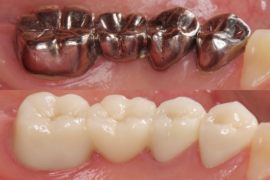 銀歯からセラミックのイメージ