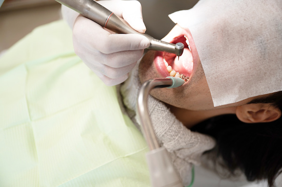 セラミック歯を削る治療