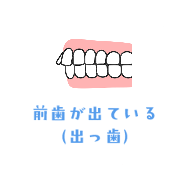 前歯が出ている（出っ歯）