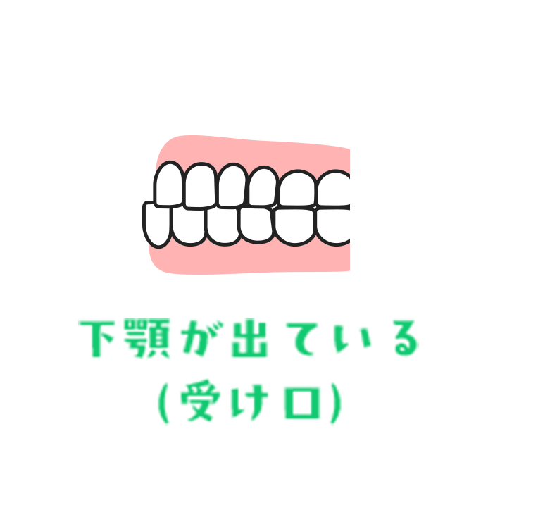 下顎が出ている（受け口）