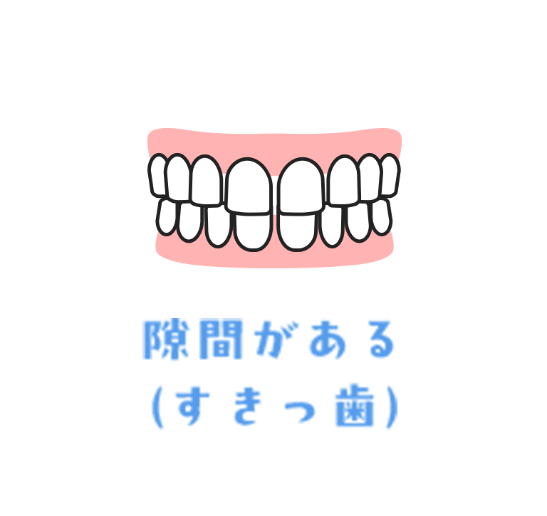 隙間がある（すきっ歯）