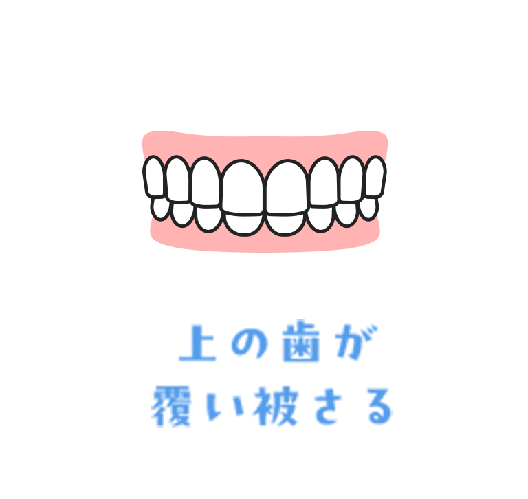 上の歯が覆い被さる