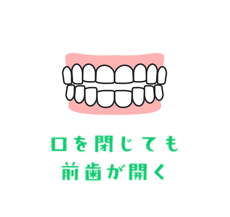 口を閉じても前歯が開く